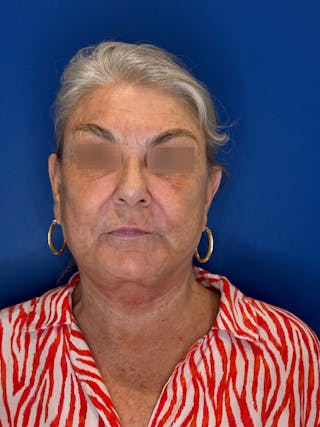 Face Lift Before & After Gallery - Patient 246199 - Image 8