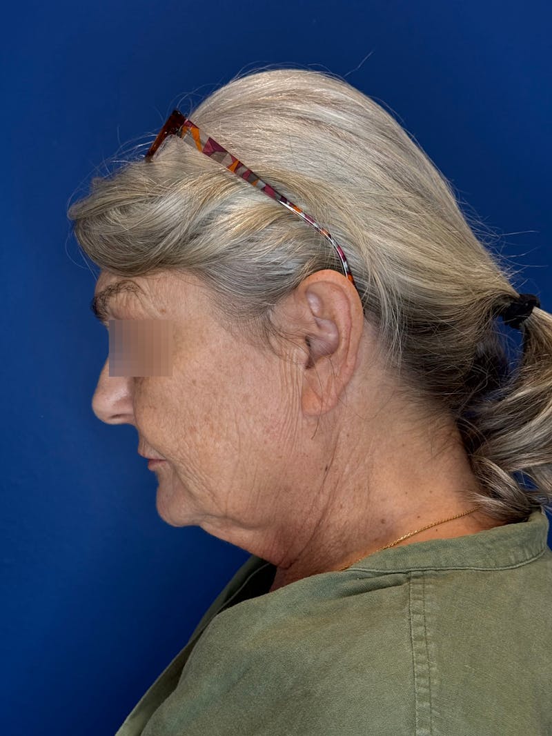 Face Lift Before & After Gallery - Patient 246199 - Image 9