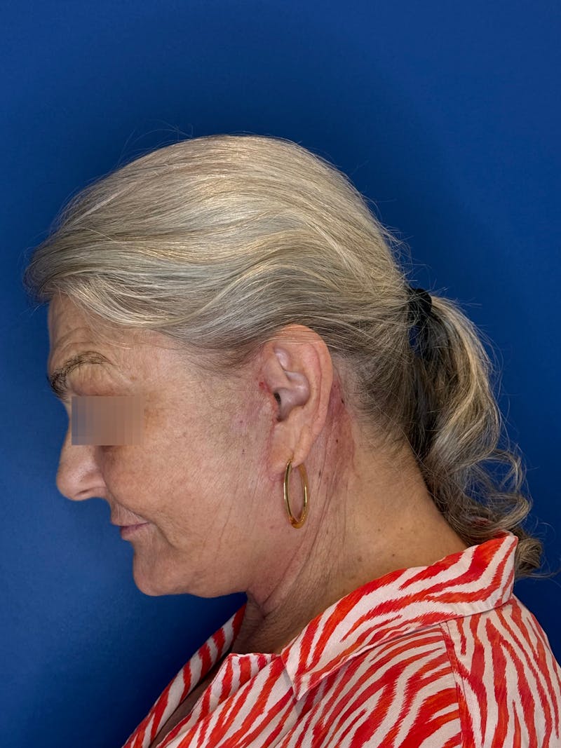 Face Lift Before & After Gallery - Patient 246199 - Image 10