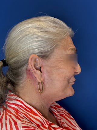 Face Lift Before & After Gallery - Patient 246199 - Image 12