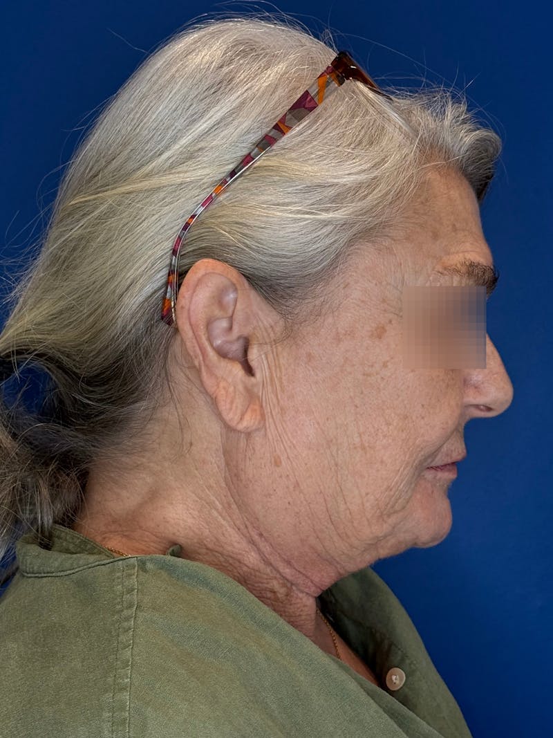 Face Lift Before & After Gallery - Patient 246199 - Image 13