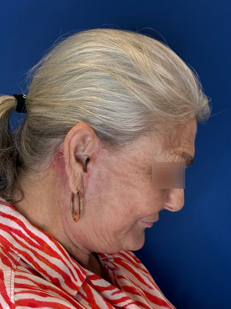 Face Lift Before & After Gallery - Patient 246199 - Image 14