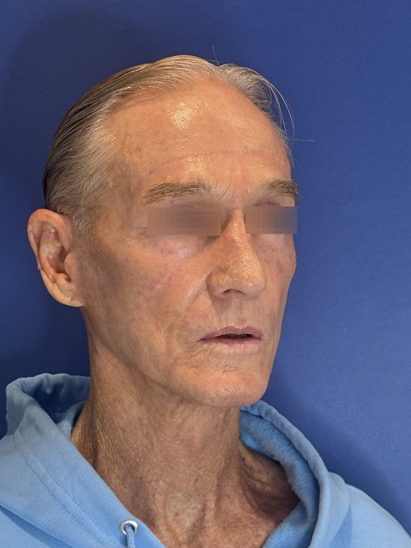 Brow Lift Before & After Gallery - Patient 212623 - Image 6