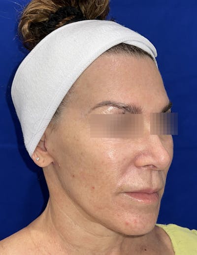 Face Lift Before & After Gallery - Patient 242829 - Image 2