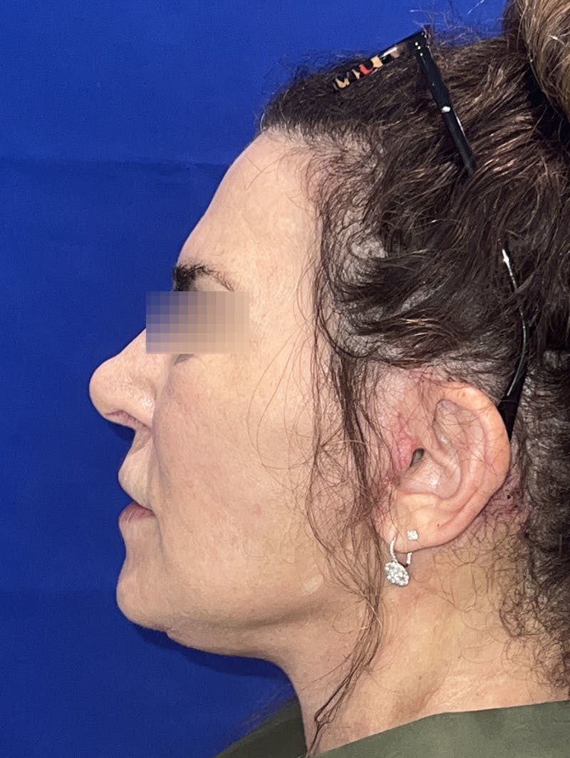 Face Lift Before & After Gallery - Patient 242829 - Image 3