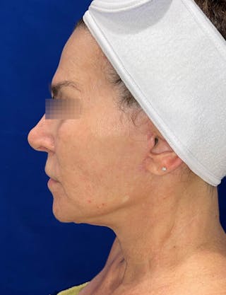 Face Lift Before & After Gallery - Patient 242829 - Image 4