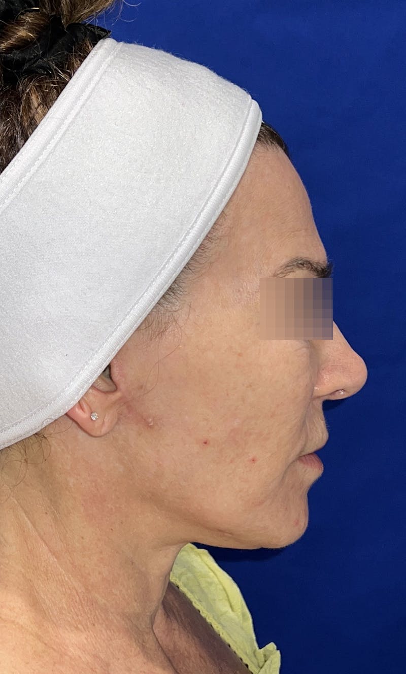Face Lift Before & After Gallery - Patient 242829 - Image 6