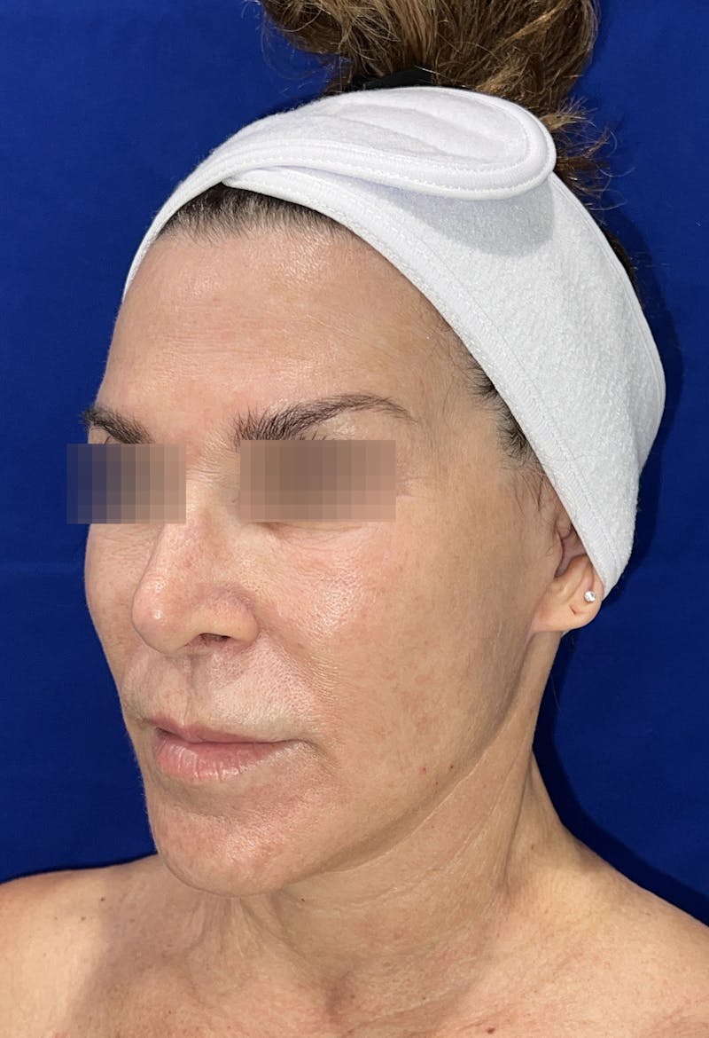 Face Lift Before & After Gallery - Patient 242829 - Image 8