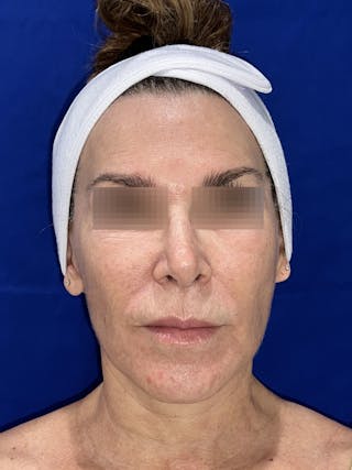 Face Lift Before & After Gallery - Patient 242829 - Image 10