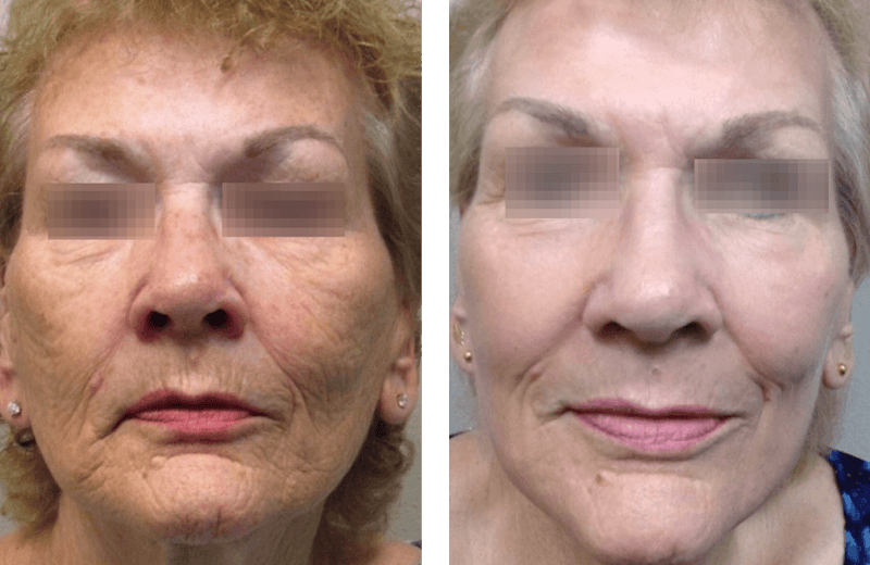 Renuvion Resurfacing Before & After Gallery - Patient 375047 - Image 1