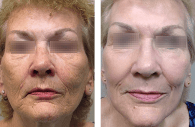 Renuvion Resurfacing Before & After Gallery - Patient 375047 - Image 1