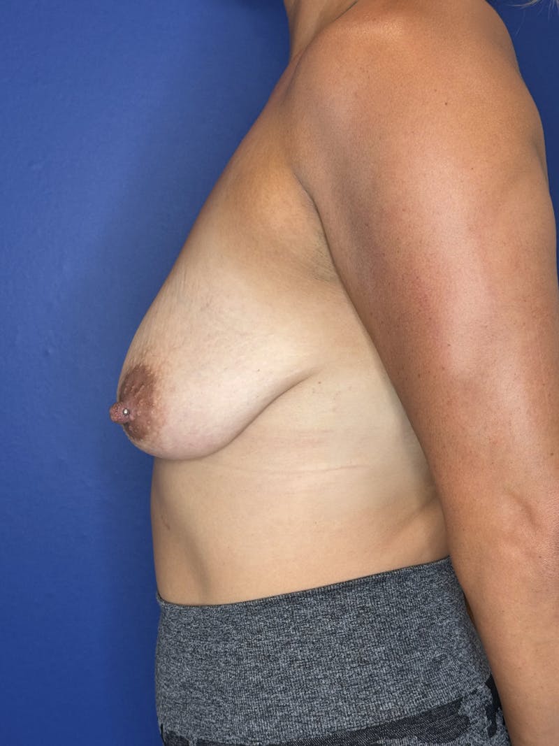 Breast Augmentation Before & After Gallery - Patient 421062 - Image 3