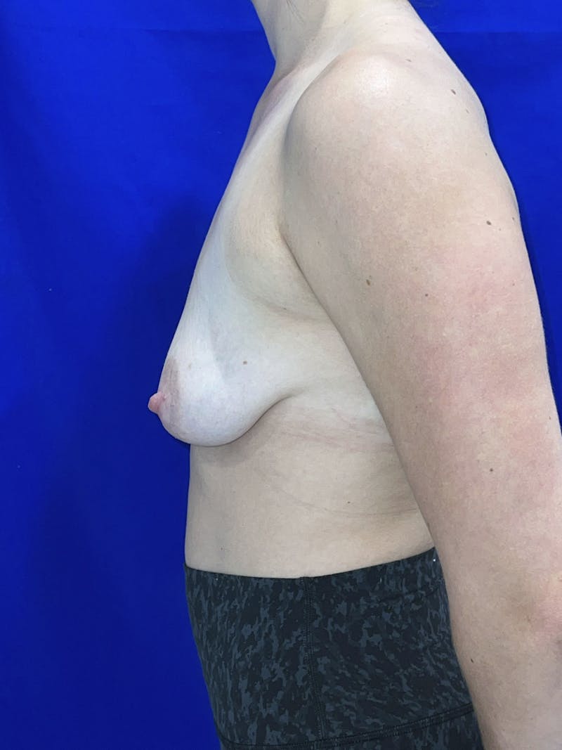 Breast Augmentation Before & After Gallery - Patient 114243 - Image 7