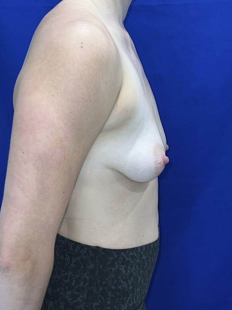 Breast Augmentation Before & After Gallery - Patient 114243 - Image 9