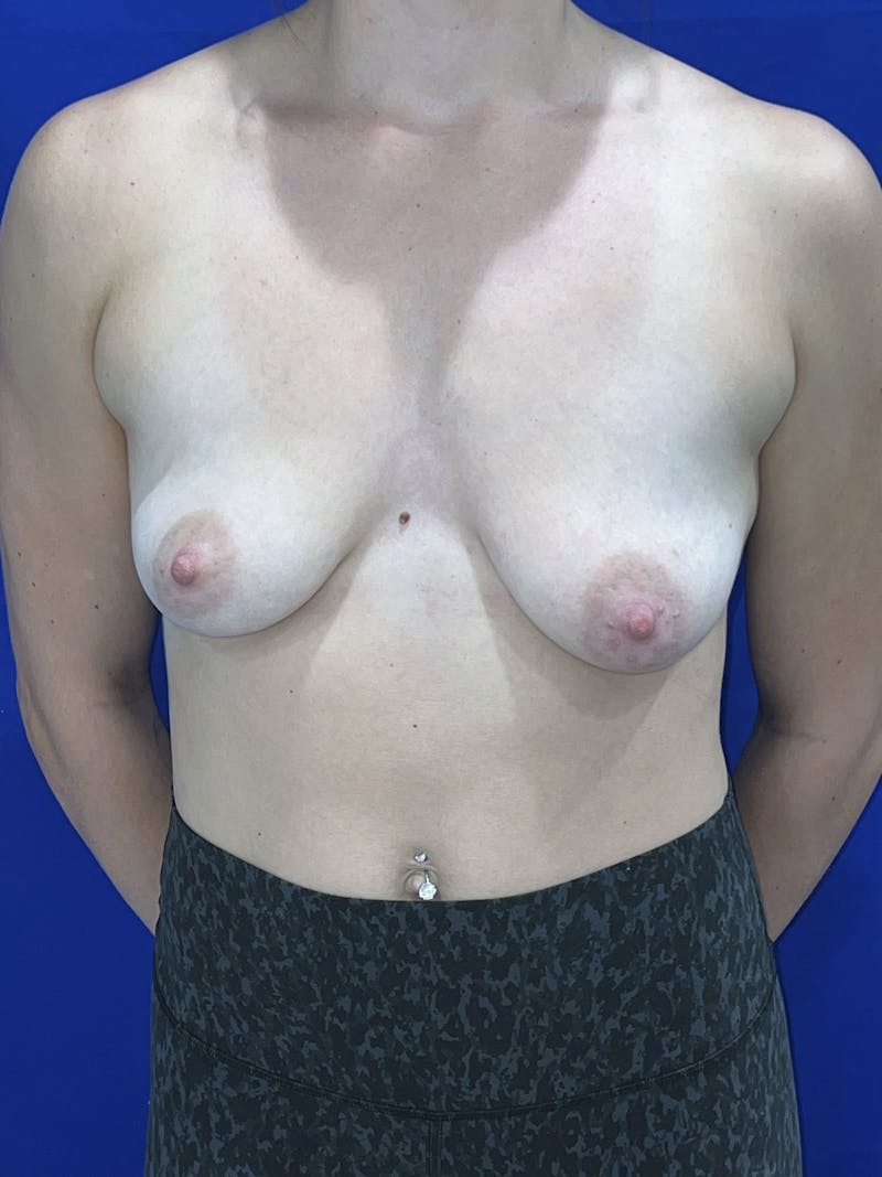 Breast Augmentation Before & After Gallery - Patient 114243 - Image 1