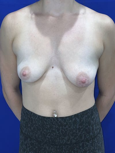 Breast Augmentation Before & After Gallery - Patient 114243 - Image 1