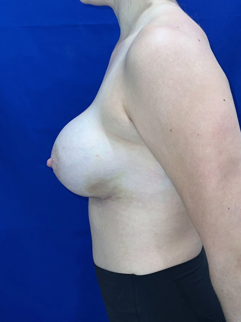 Breast Augmentation Before & After Gallery - Patient 114243 - Image 8
