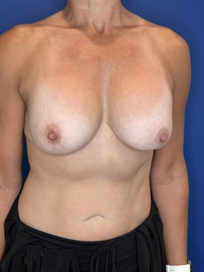 Implant Removal Before & After Gallery - Patient 153543 - Image 1