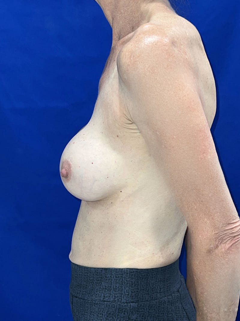 Implant Removal & Replace Before & After Gallery - Patient 207544 - Image 7