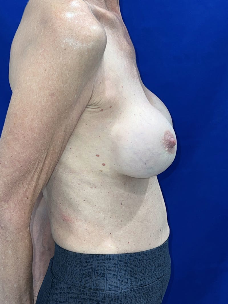 Implant Removal & Replace Before & After Gallery - Patient 207544 - Image 5