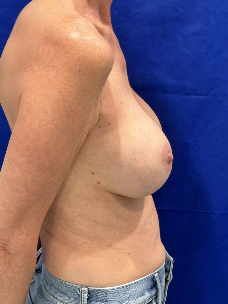 Implant Removal & Replace Before & After Gallery - Patient 207544 - Image 6