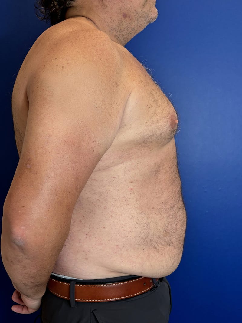 Tummy Tuck Before & After Gallery - Patient 831347 - Image 3