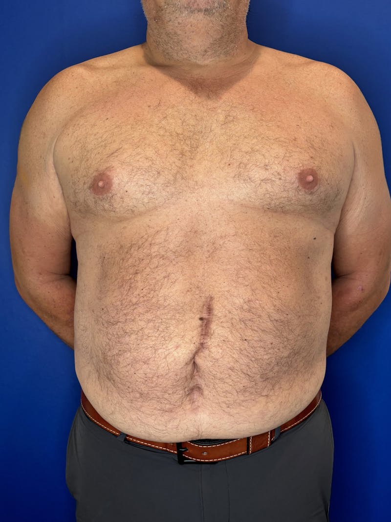 Tummy Tuck Before & After Gallery - Patient 831347 - Image 7