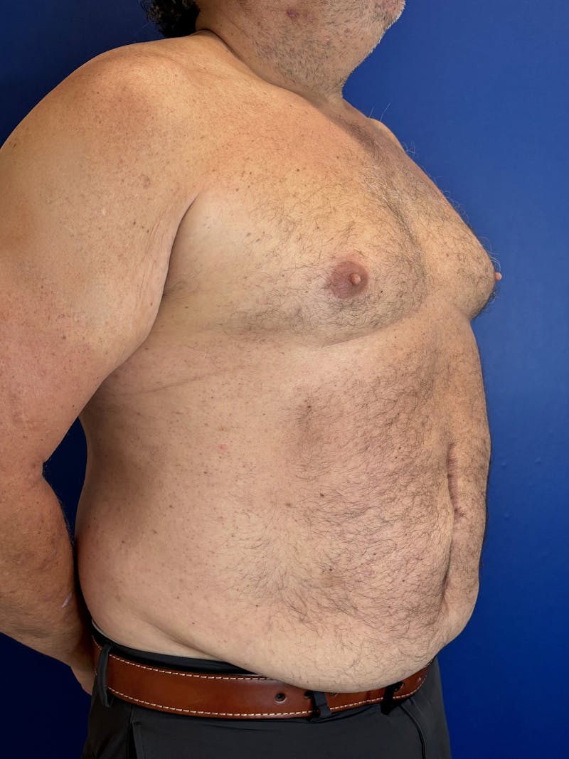 Tummy Tuck Before & After Gallery - Patient 831347 - Image 1