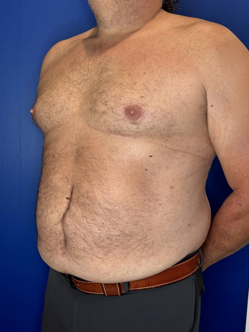 Tummy Tuck Before & After Gallery - Patient 831347 - Image 5