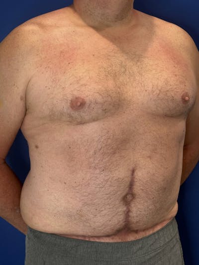 Tummy Tuck Before & After Gallery - Patient 831347 - Image 2