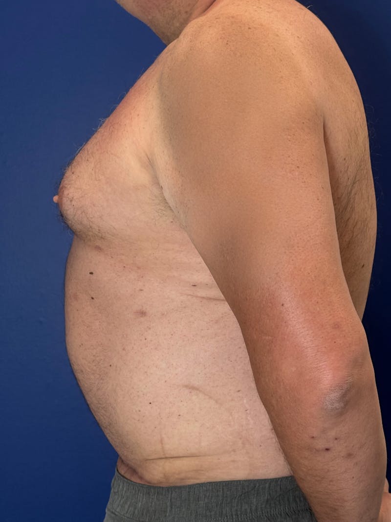 Tummy Tuck Before & After Gallery - Patient 831347 - Image 10