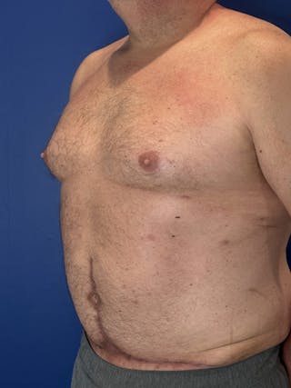 Tummy Tuck Before & After Gallery - Patient 831347 - Image 6