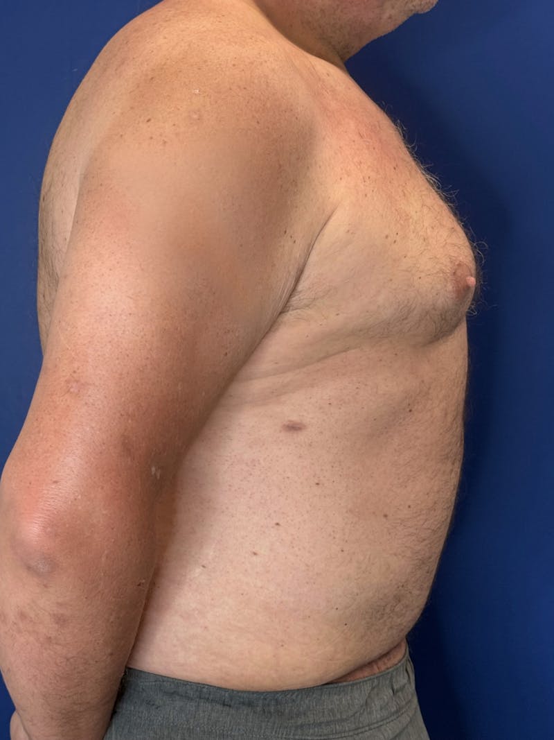 Tummy Tuck Before & After Gallery - Patient 831347 - Image 4