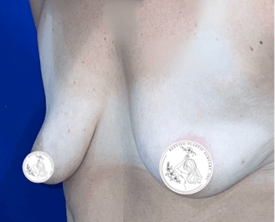 Breast Augmentation Before & After Gallery - Patient 236736 - Image 1