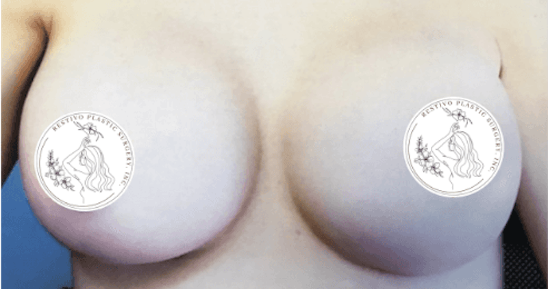 Breast Augmentation Before & After Gallery - Patient 564814 - Image 2