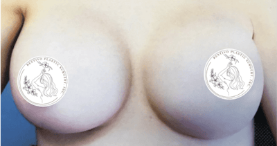 Breast Augmentation Before & After Gallery - Patient 564814 - Image 2