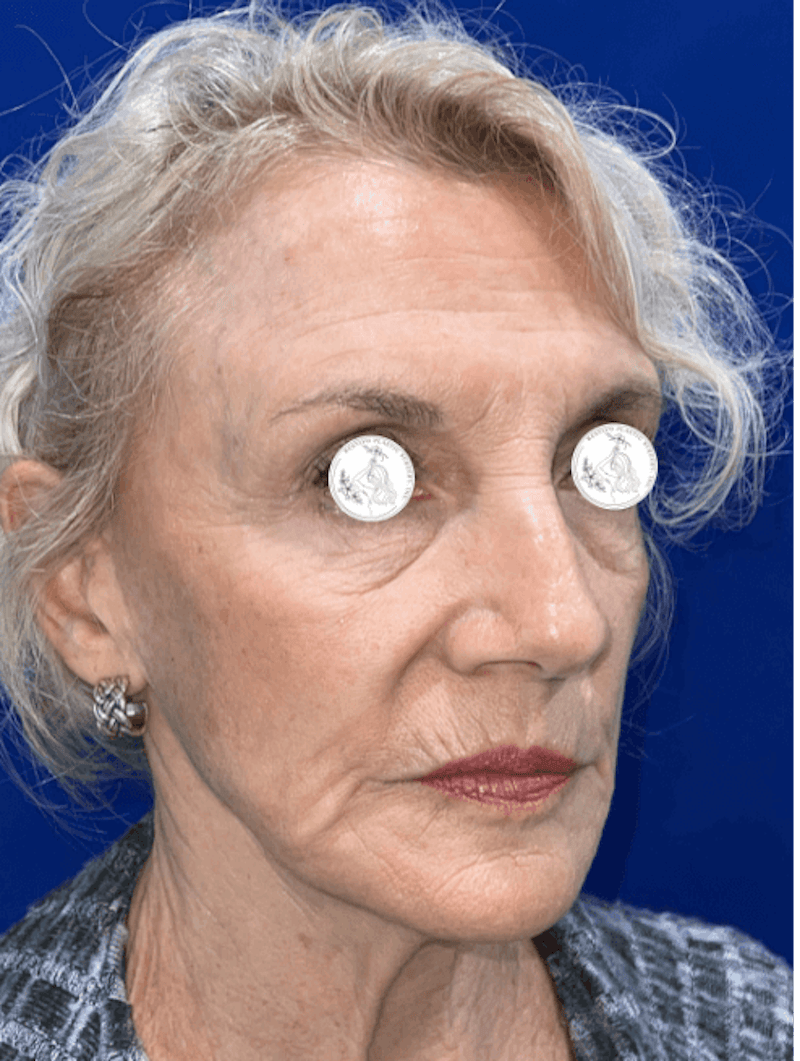 Face Lift Before & After Gallery - Patient 306856 - Image 1