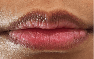 Lip Filler Before & After Gallery - Patient 999427 - Image 1