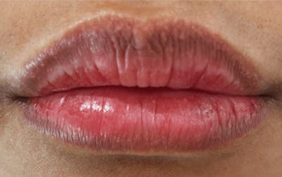 Lip Filler Before & After Gallery - Patient 999427 - Image 2