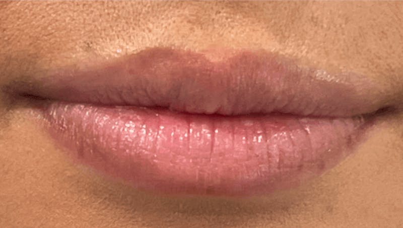 Lip Filler Before & After Gallery - Patient 100083 - Image 1