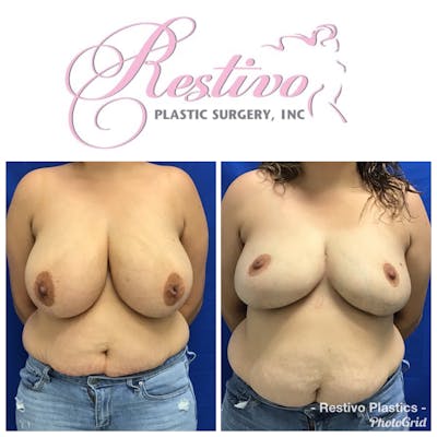 Breast Reduction Before & After Gallery - Patient 165558 - Image 1