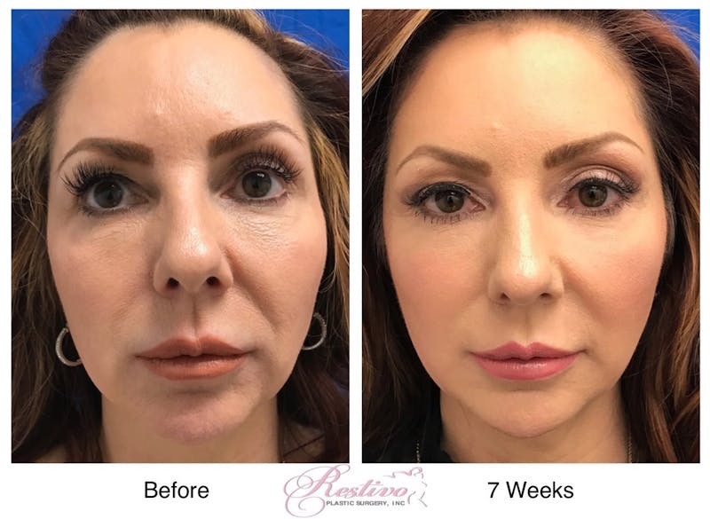 Renuvion Resurfacing Before & After Gallery - Patient 151422 - Image 1