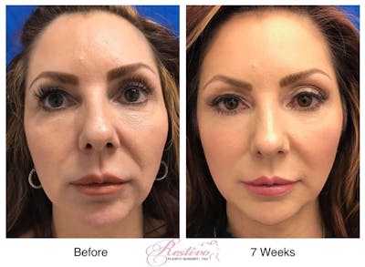 Renuvion Resurfacing Before & After Gallery - Patient 151422 - Image 1