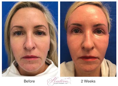 Renuvion Resurfacing Before & After Gallery - Patient 387785 - Image 1