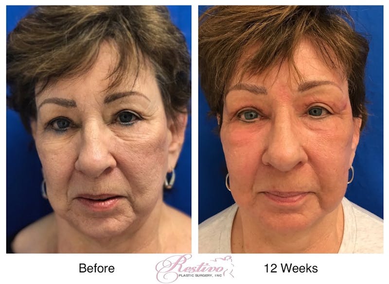 Renuvion Resurfacing Before & After Gallery - Patient 129735 - Image 1