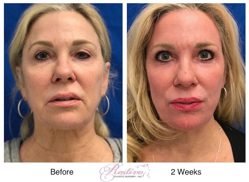 Renuvion Resurfacing Before & After Gallery - Patient 349485 - Image 1