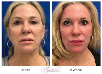 Renuvion Resurfacing Before & After Gallery - Patient 349485 - Image 1