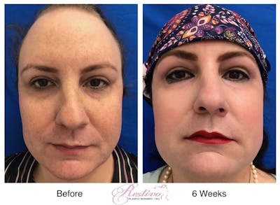 Renuvion Resurfacing Before & After Gallery - Patient 292794 - Image 1