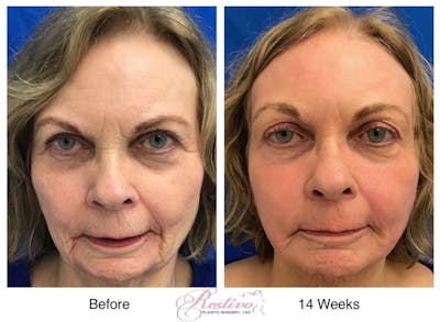 Renuvion Resurfacing Before & After Gallery - Patient 696278 - Image 1