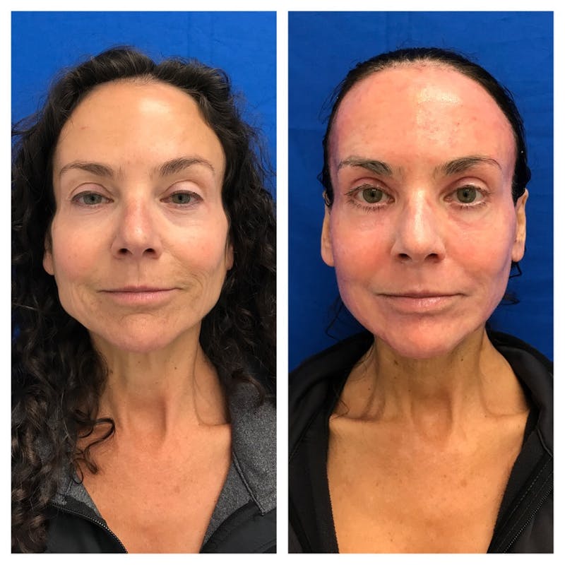 Renuvion Resurfacing Before & After Gallery - Patient 151876 - Image 1